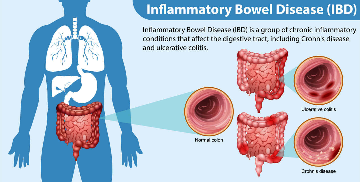 Inflammatory Bowel Disease (IBD): Types, Symptoms, Treatment - StoryMD